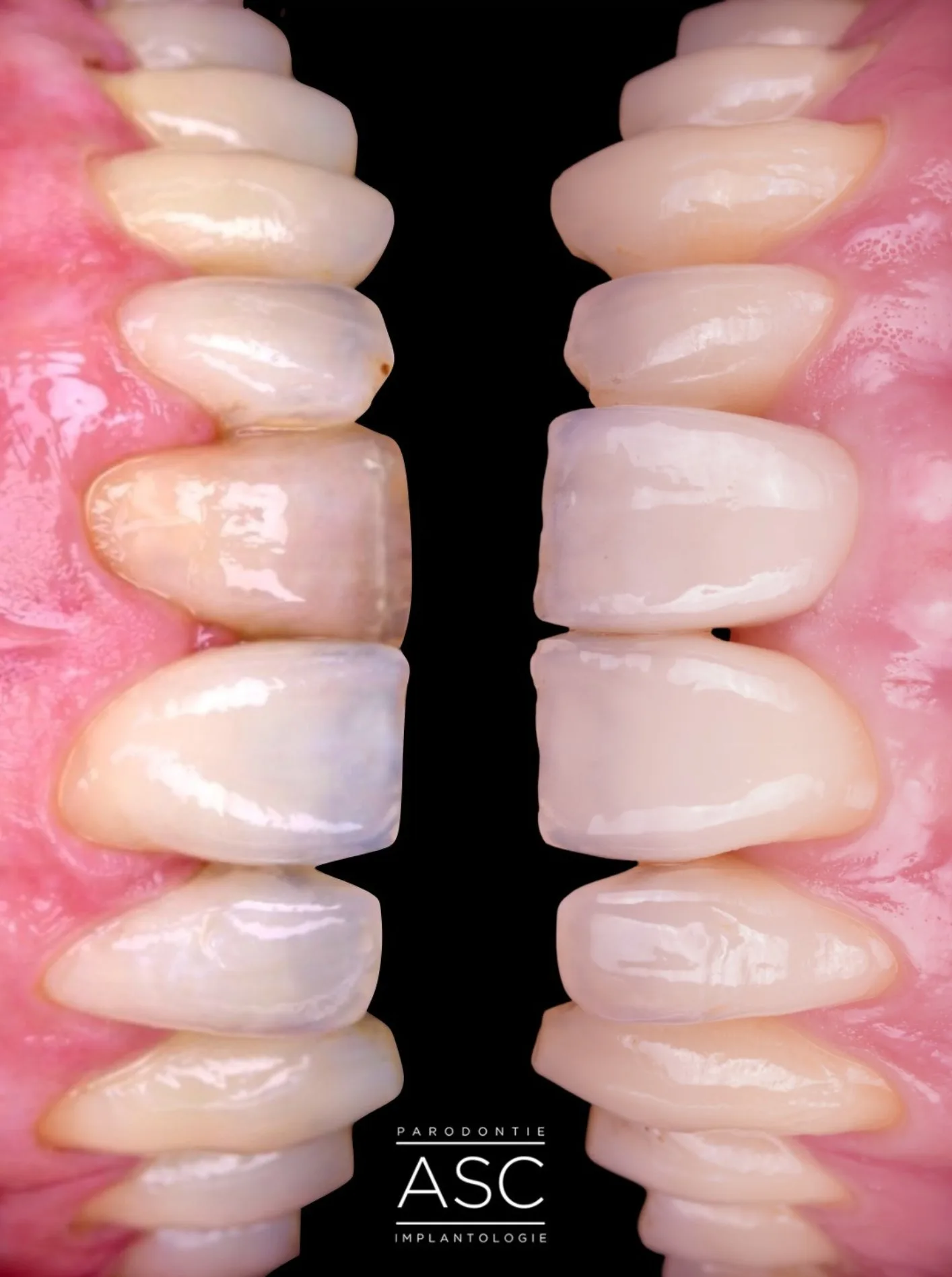 Cas clinique implants